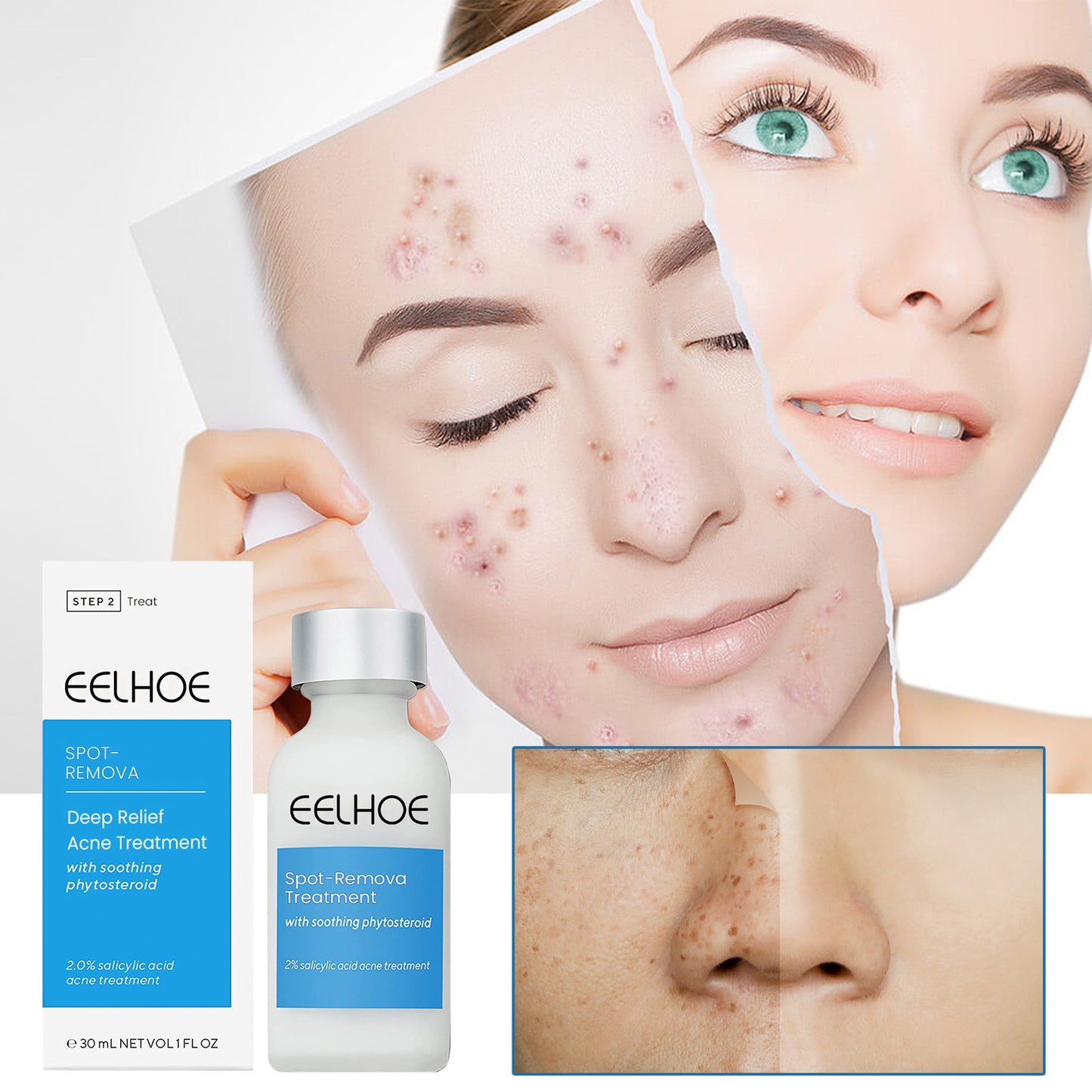 Lotion réparatrice d’acné EELHOE vitamines B3 et B5